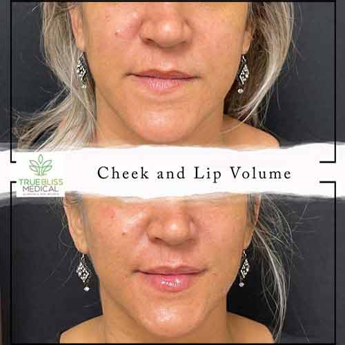 Cheek Fillers Before & After in Verona, NJ