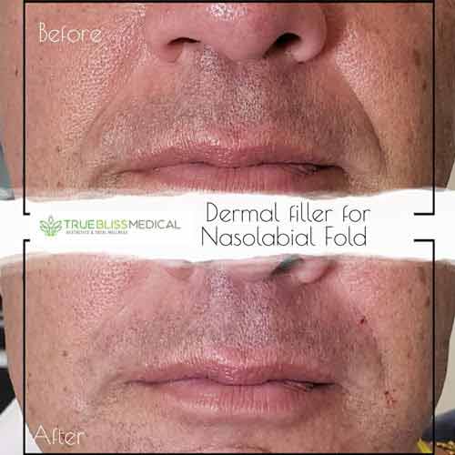 Dermal Fillers Before & After in Verona, NJ