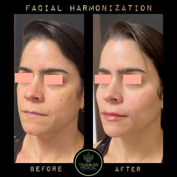 Facial Contouring Before & After in Verona, NJ