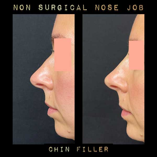 Non-Surgical Rhinoplasty Before & After in Verona, NJ