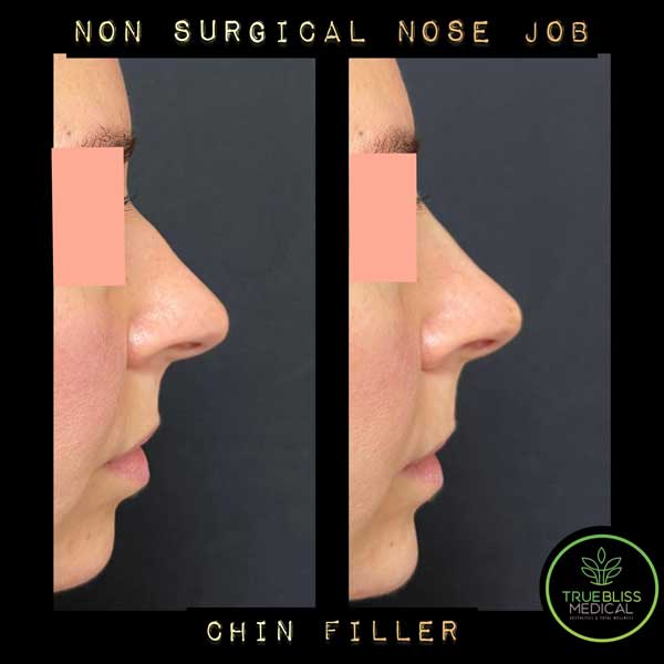 Non-Surgical Rhinoplasty Before & After in Verona, NJ