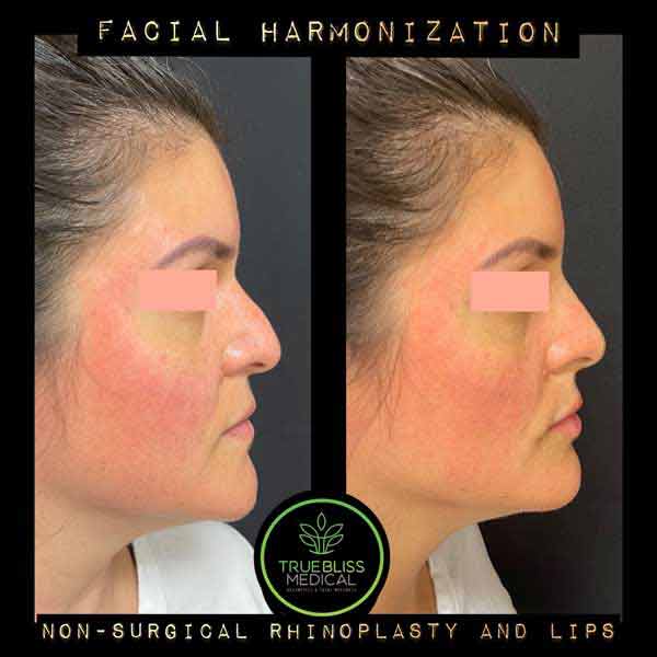 Facial Contouring Before & After in Verona, NJ