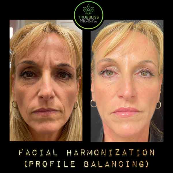 Facial Contouring Before & After in Verona, NJ