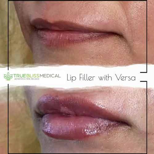 Dermal Fillers Before & After in Verona, NJ