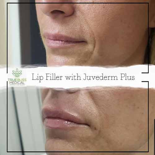 Dermal Fillers Before & After in Verona, NJ