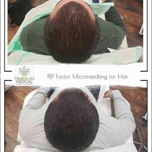 Hair Restoration Treatment Before & After in Verona, NJ