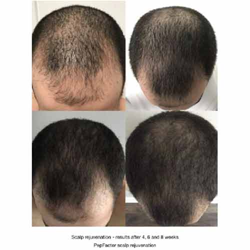 Hair Restoration Treatment Before & After in Verona, NJ