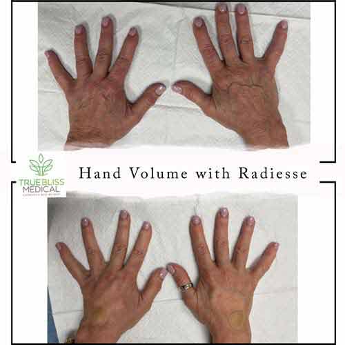 Hands Rejuvenation Treatment Before & After in Verona, NJ