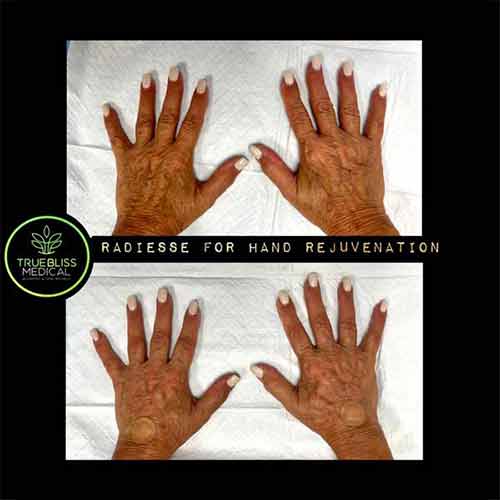 Hands Rejuvenation Treatment Before & After in Verona, NJ