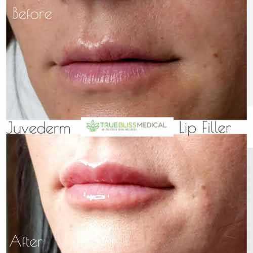 Dermal Fillers Before & After in Verona, NJ