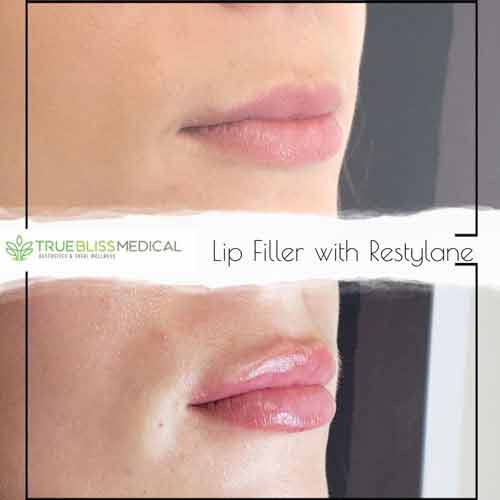 Dermal Fillers Before & After in Verona, NJ