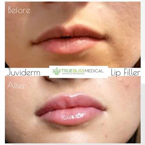 Lip Treatments Before & After in Verona, NJ