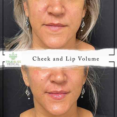 Lip Treatments Before & After in Verona, NJ