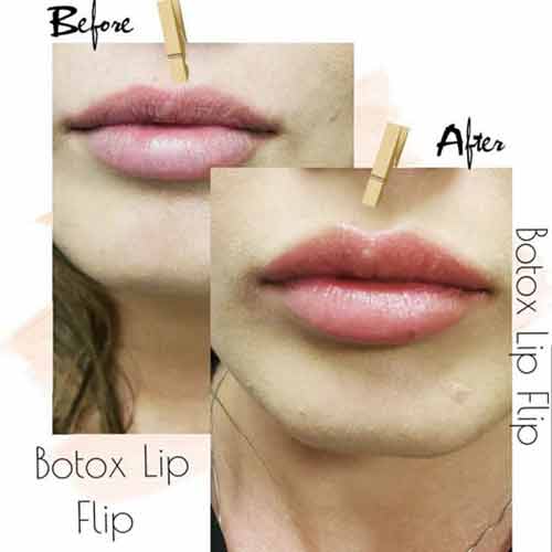 Lip Treatments Before & After in Verona, NJ