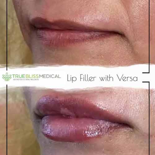 Lip Treatments Before & After in Verona, NJ