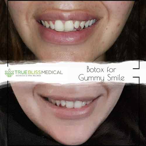 Lip Treatments Before & After in Verona, NJ