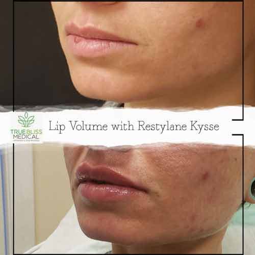 Lip Treatments Before & After in Verona, NJ