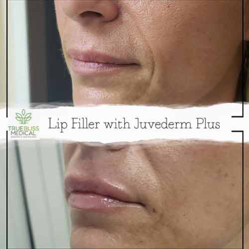 Lip Treatments Before & After in Verona, NJ