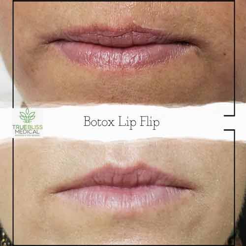 Lip Treatments Before & After in Verona, NJ Lip Treatments Before & After in Verona, NJ