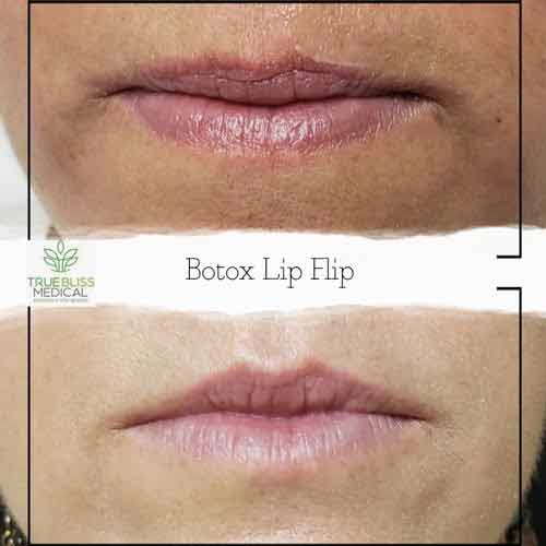 Lip Treatments Before & After in Verona, NJ