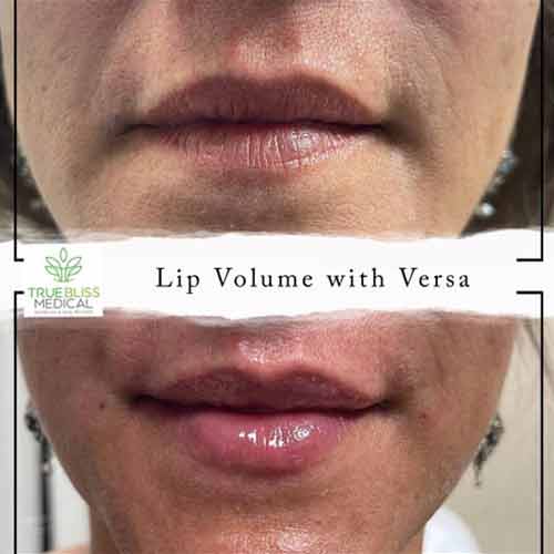 Lip Treatments Before & After in Verona, NJ