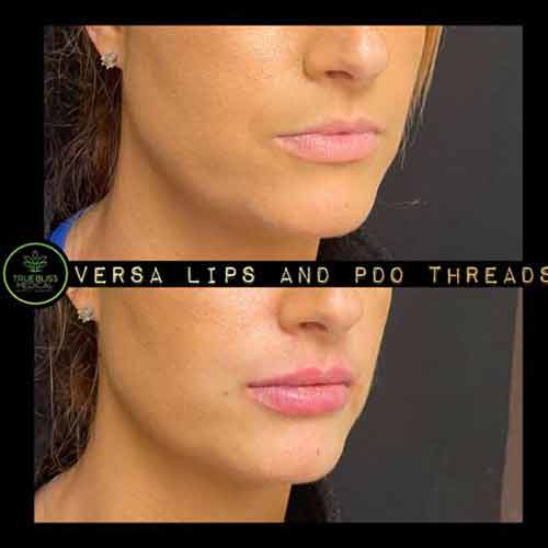 Lip Treatments Before & After in Verona, NJ