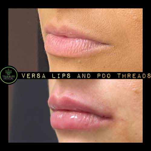Lip Treatments Before & After in Verona, NJ Lip Treatments Before & After in Verona, NJ