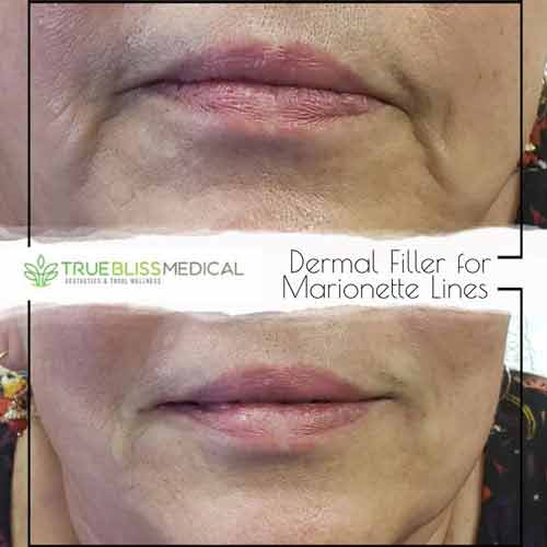 Nasolabial Folds & Marionette Lines Treatment Before & After in Verona, NJ