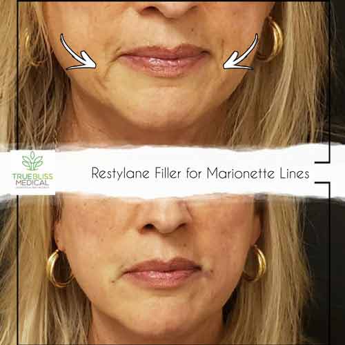 Nasolabial Folds & Marionette Lines Treatment Before & After in Verona, NJ