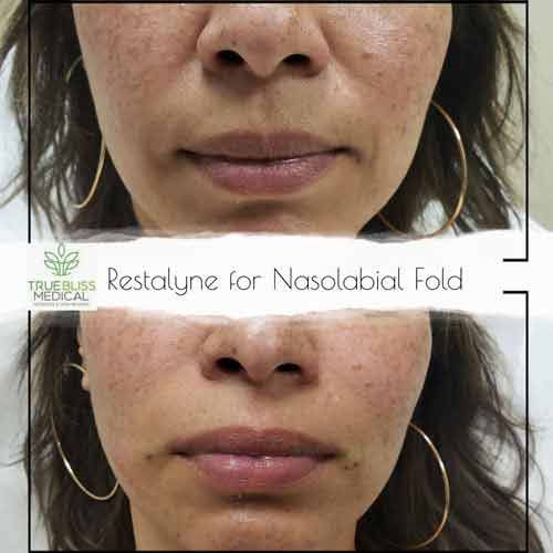 Nasolabial Folds & Marionette Lines Treatment Before & After in Verona, NJ