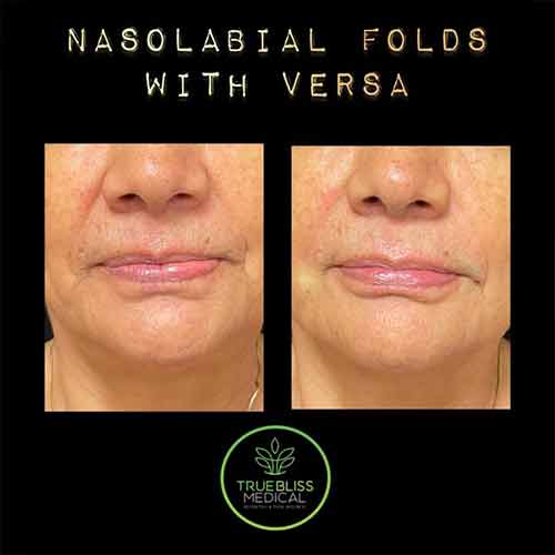 Nasolabial Folds & Marionette Lines Treatment Before & After in Verona, NJ