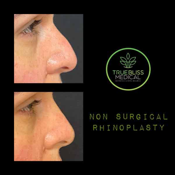 Non-Surgical Rhinoplasty Treatment in Verona NJ