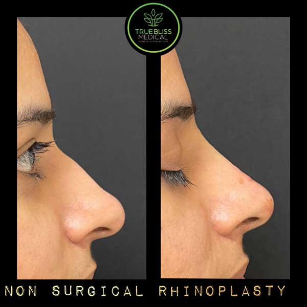 Non-Surgical Rhinoplasty Before & After in Verona, NJ