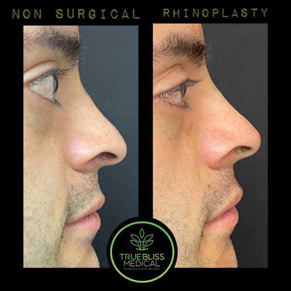 Non-Surgical Rhinoplasty Before & After in Verona, NJ