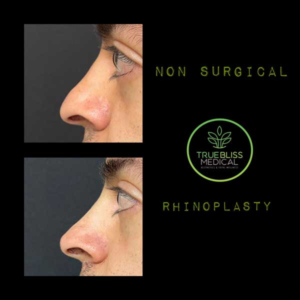 Non-Surgical Rhinoplasty Before & After in Verona, NJ