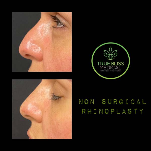 Non-Surgical Rhinoplasty Before & After in Verona, NJ