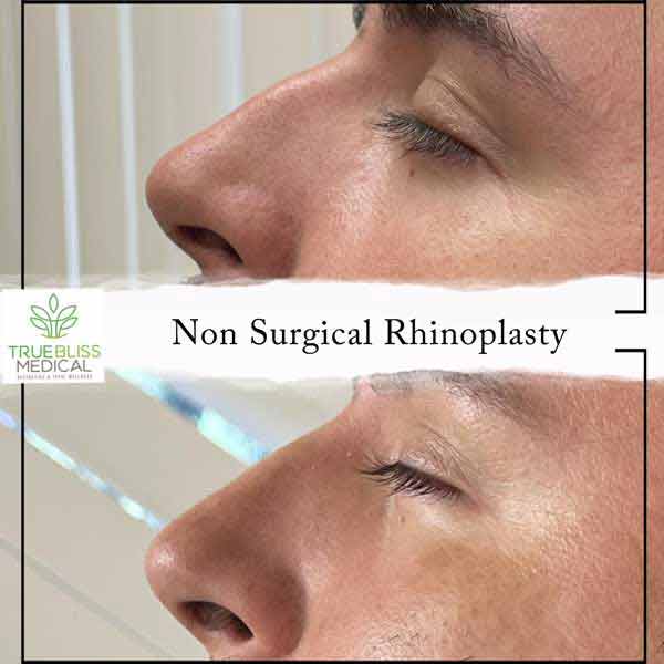 Non-Surgical Rhinoplasty Before & After in Verona, NJ