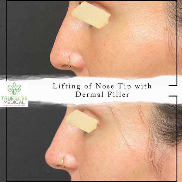 Non-Surgical Rhinoplasty Before & After in Verona, NJ