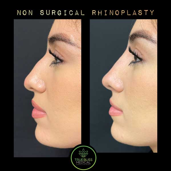 Non-Surgical Rhinoplasty Treatment in Verona NJ