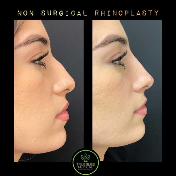 Non-Surgical Rhinoplasty Treatment in Verona NJ