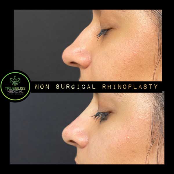 Non-Surgical Rhinoplasty Treatment in Verona NJ