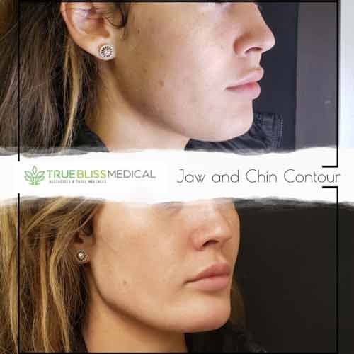 Dermal Fillers Before & After in Verona, NJ