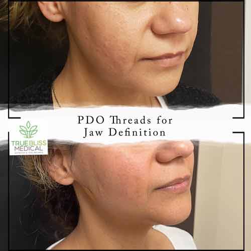 Dermal Fillers Before & After in Verona, NJ