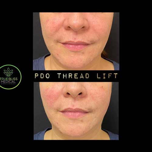 PDO Threads Lift Treatment Before & After in Verona, NJ