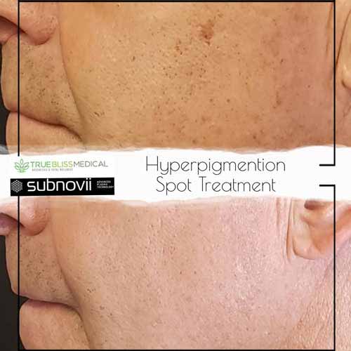 Subnovii Fibroblast Pen Treatment Before & After in Verona, NJ