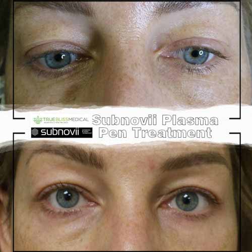 Subnovii Fibroblast Pen Treatment Before & After in Verona, NJ
