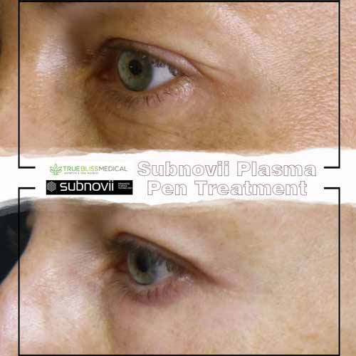 Subnovii Fibroblast Pen Treatment Before & After in Verona, NJ