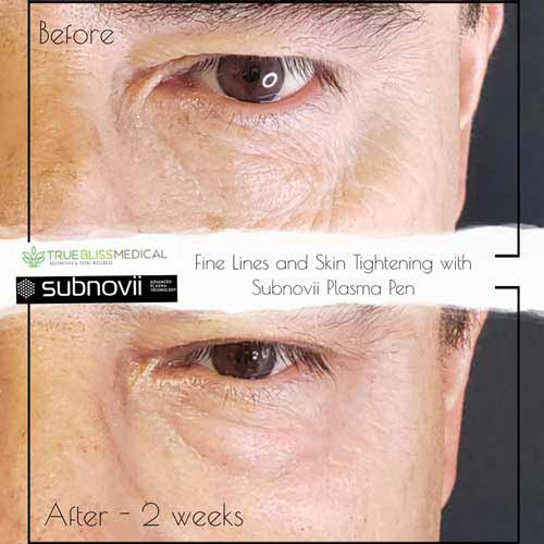 Subnovii Fibroblast Pen Treatment Before & After in Verona, NJ