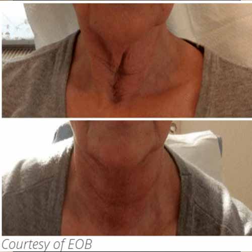 Subnovii Fibroblast Pen Treatment Before & After in Verona, NJ