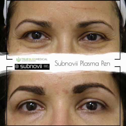 Subnovii Fibroblast Pen Treatment Before & After in Verona, NJ